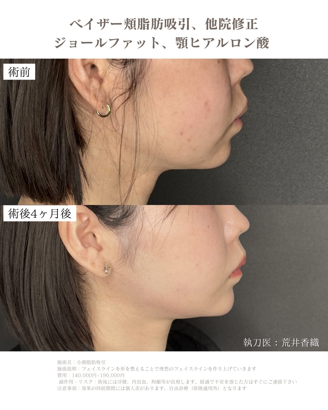 小顔脂肪吸引