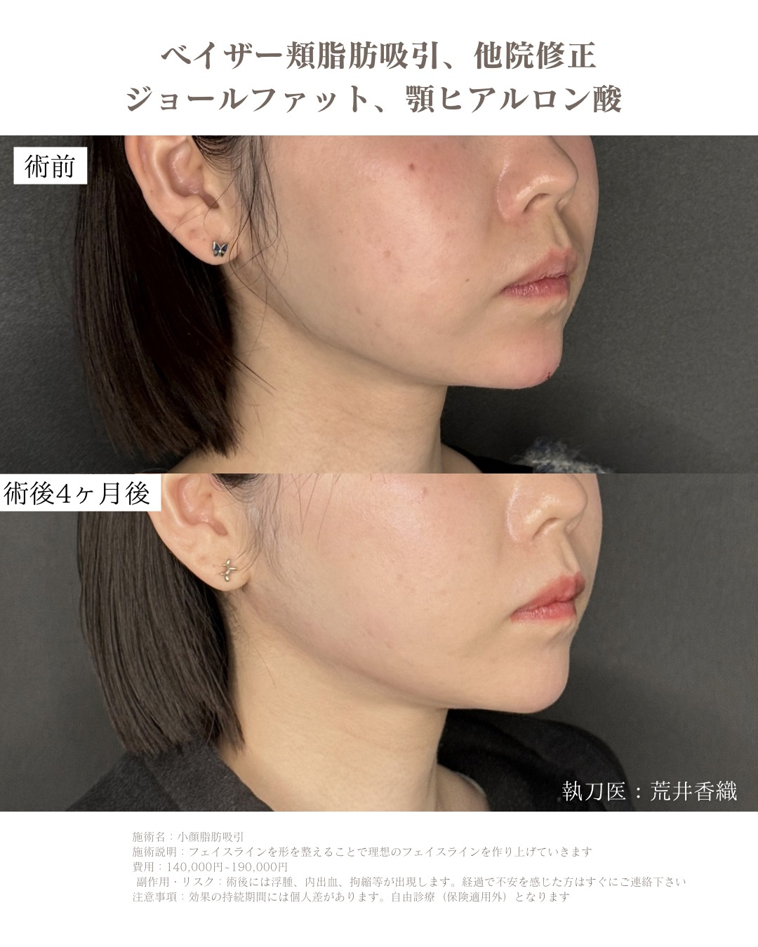 小顔脂肪吸引