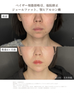 小顔脂肪吸引