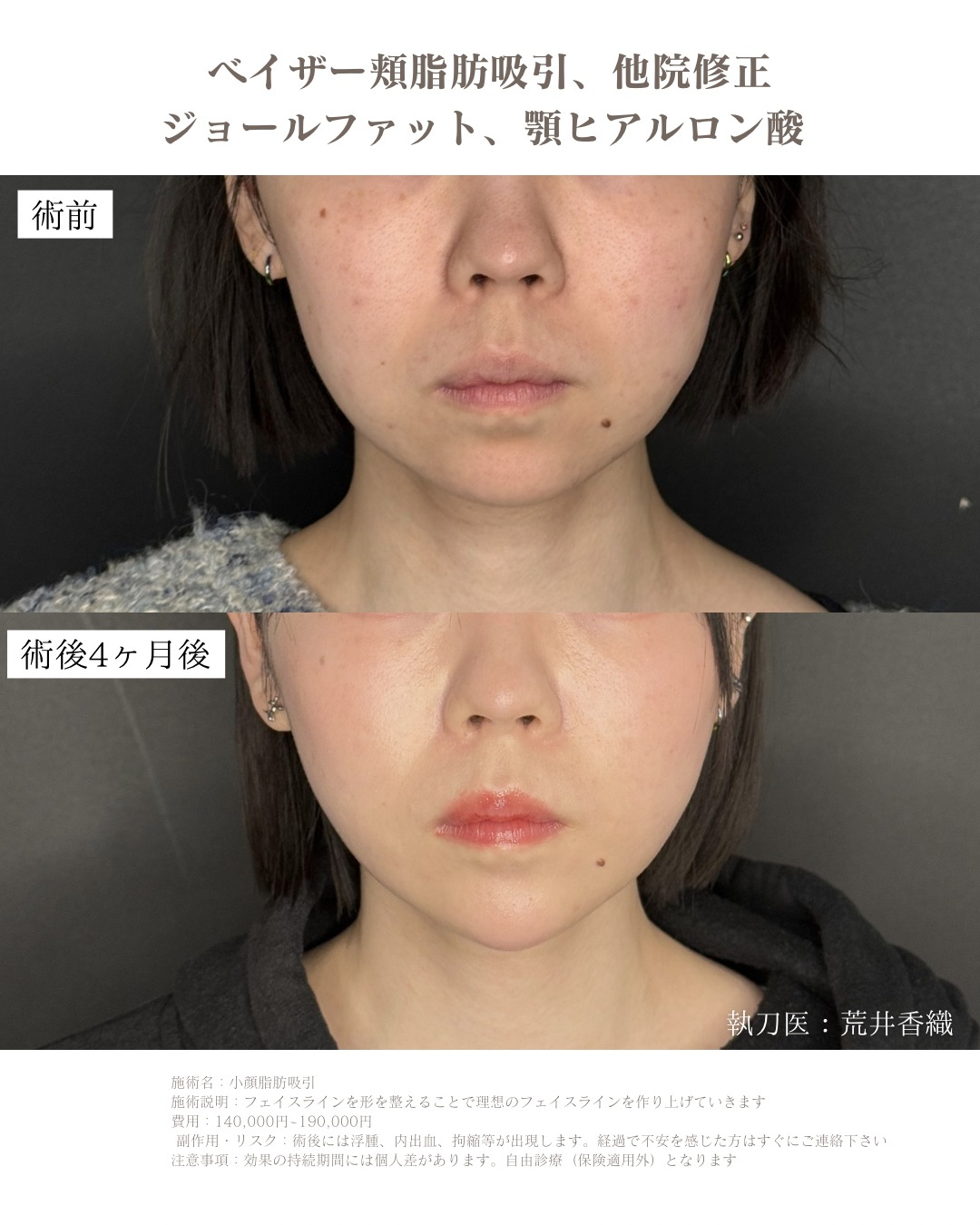 小顔脂肪吸引