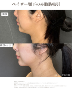 顎下脂肪吸引