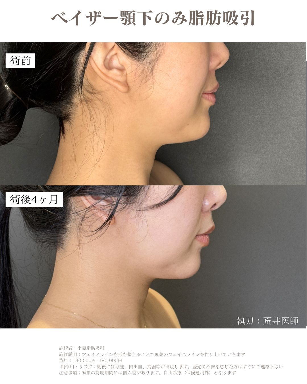 顎下脂肪吸引