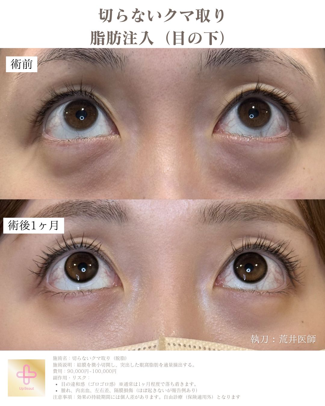 目の下の脱脂、脂肪注入（目の下）