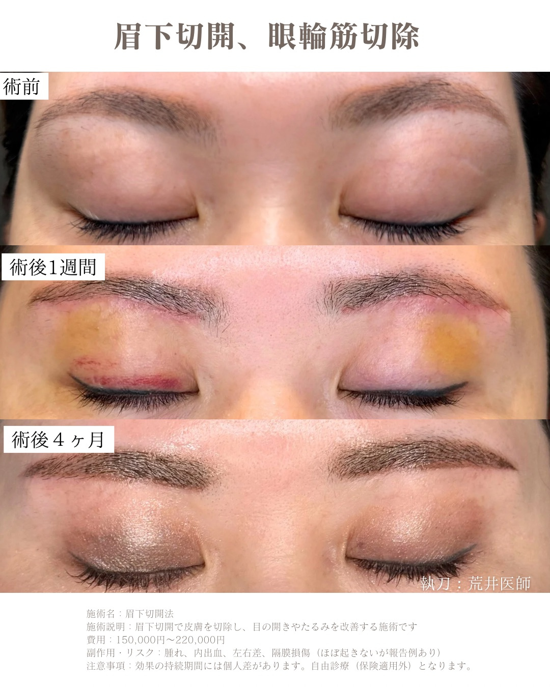 眉下切開　眼輪筋切除