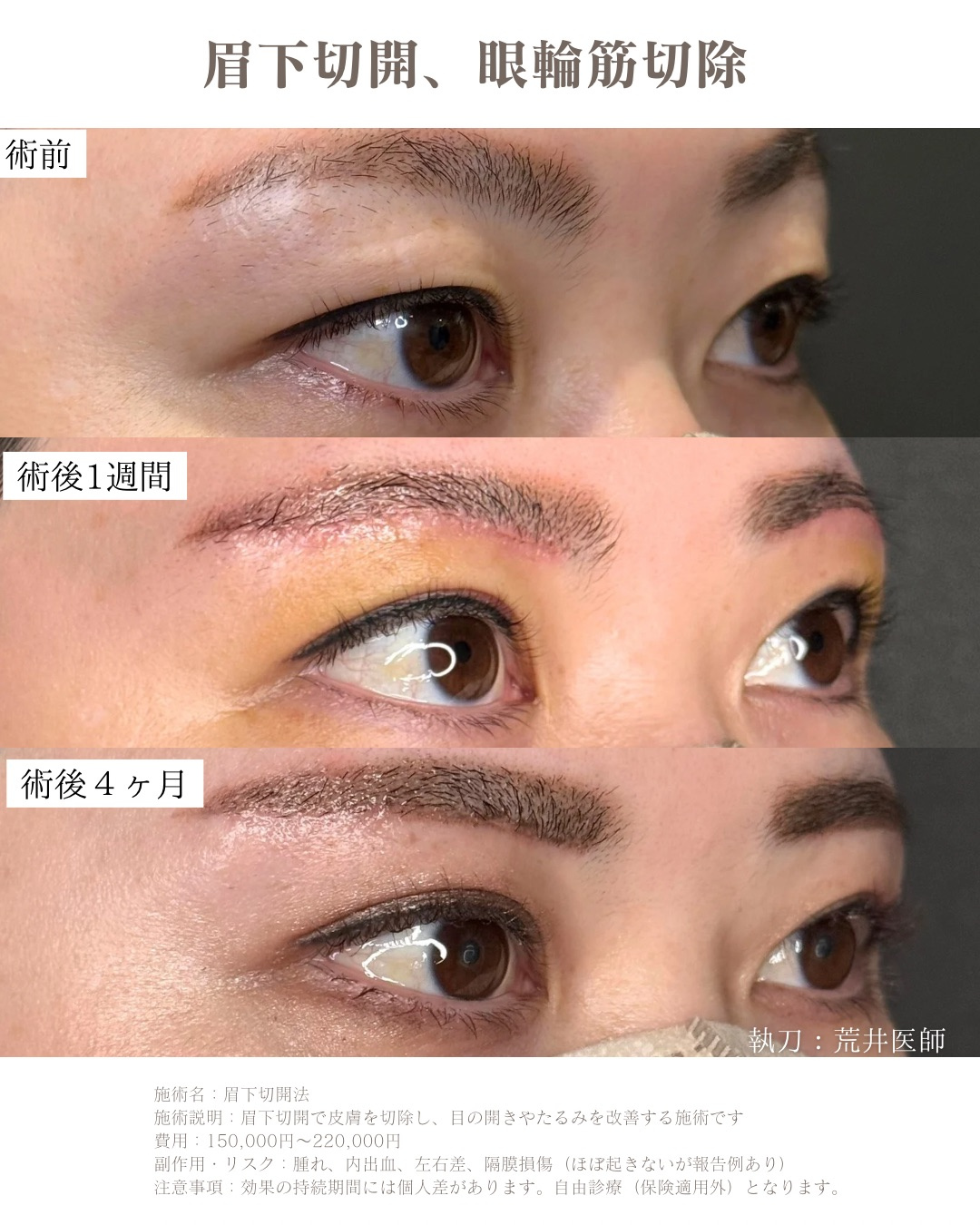 眉下切開　眼輪筋切除