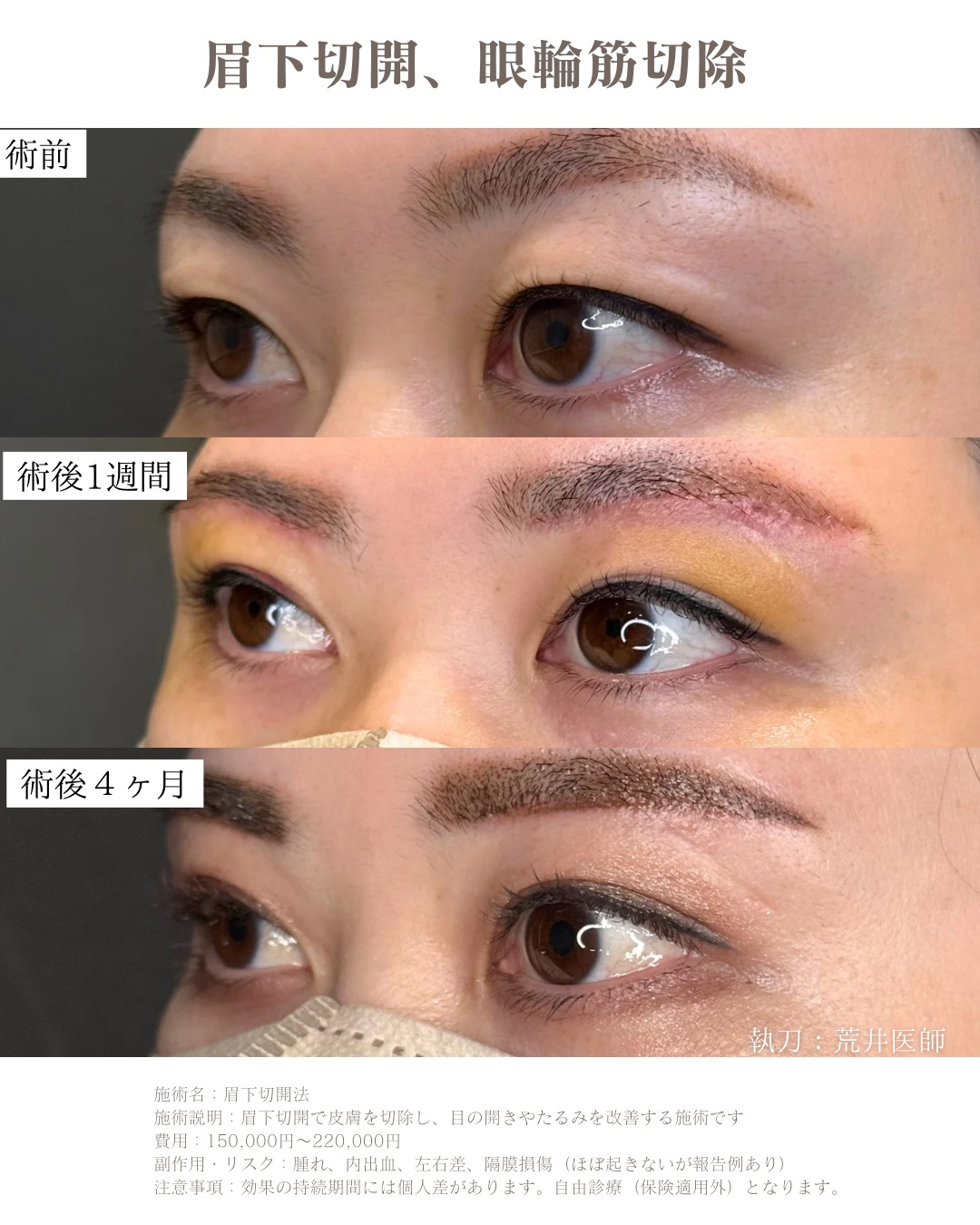 眉下切開　眼輪筋切除