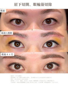眉下切開　眼輪筋切除
