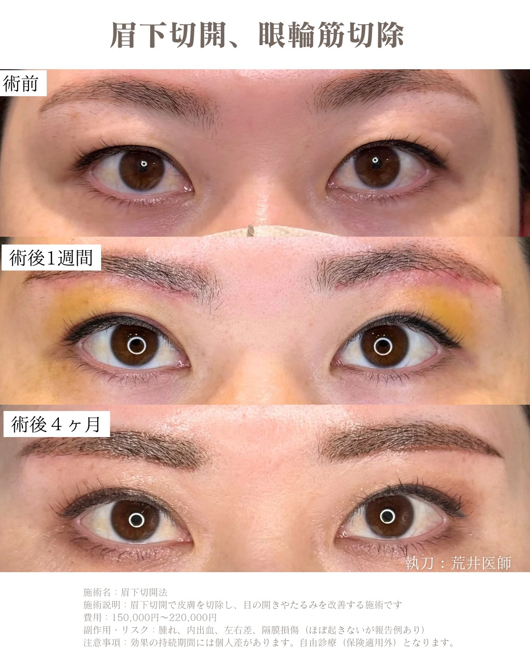 眉下切開　眼輪筋切除