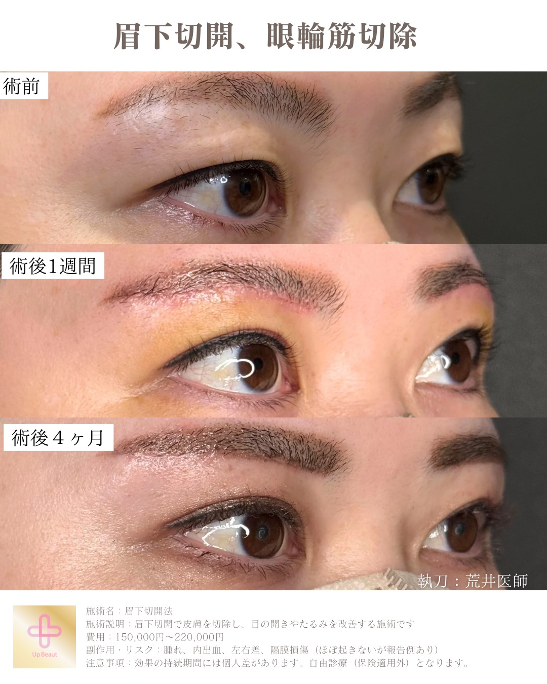 眉下切開、眼輪筋切除