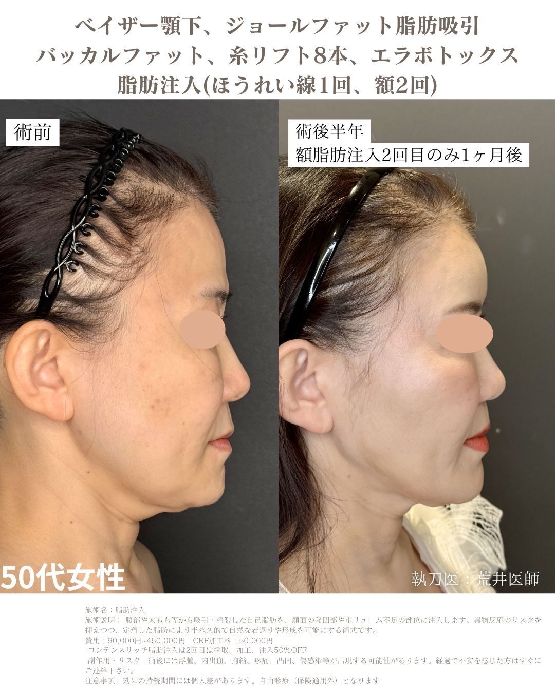 小顔脂肪吸引　脂肪注入