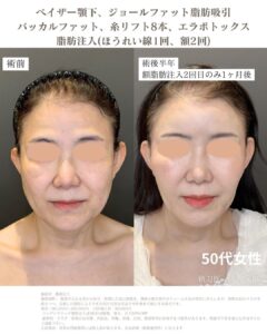 小顔脂肪吸引　脂肪注入