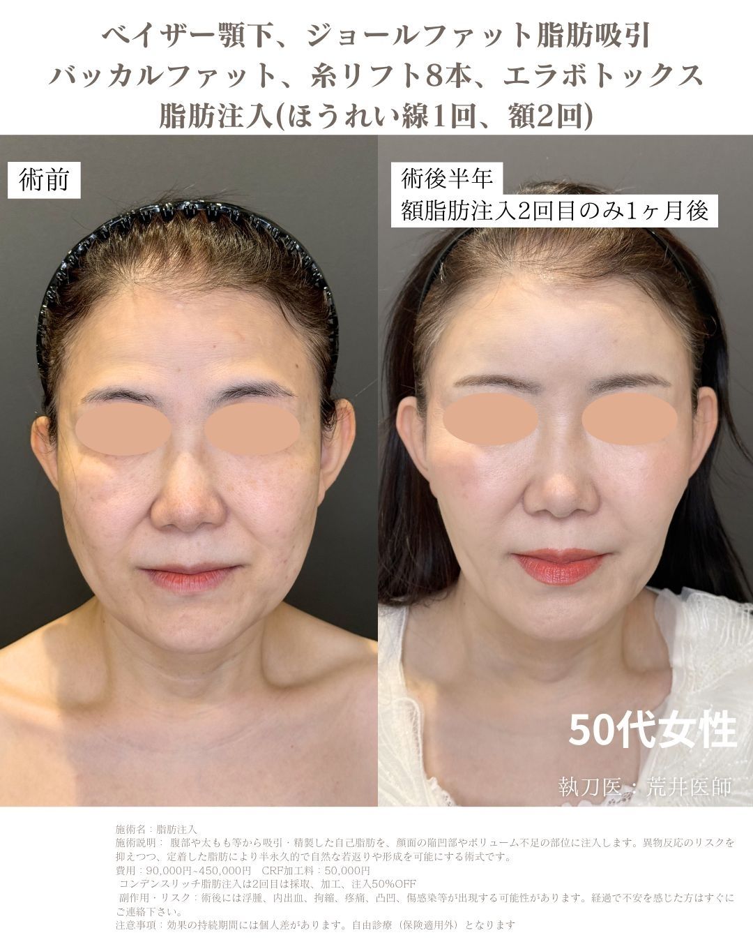 小顔脂肪吸引　脂肪注入