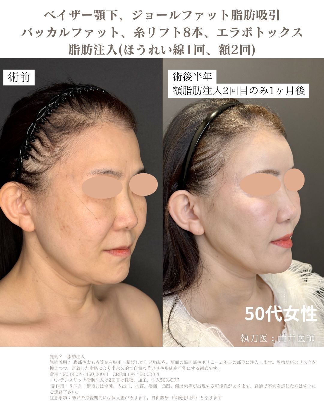 小顔脂肪吸引　脂肪注入
