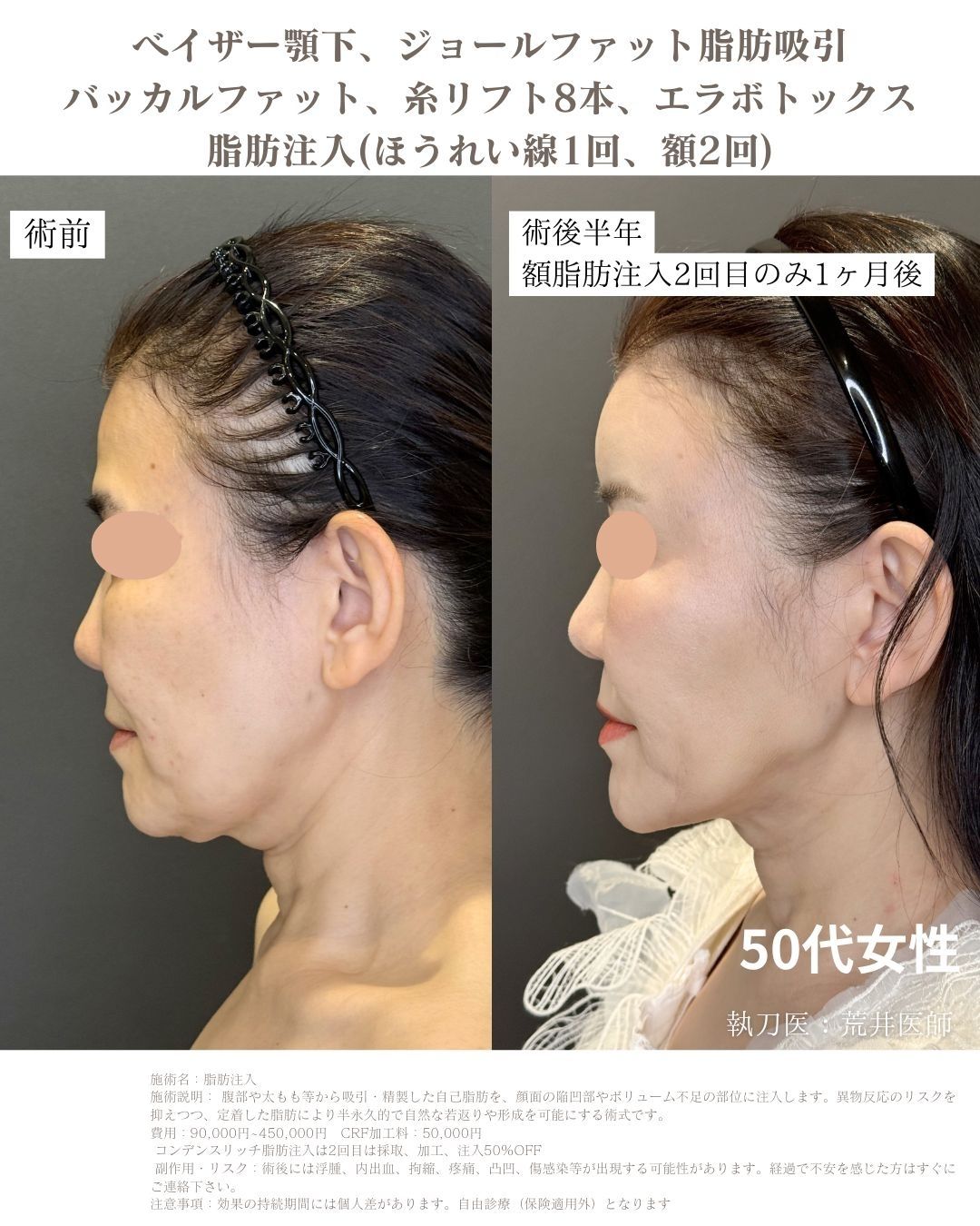 小顔脂肪吸引　脂肪注入
