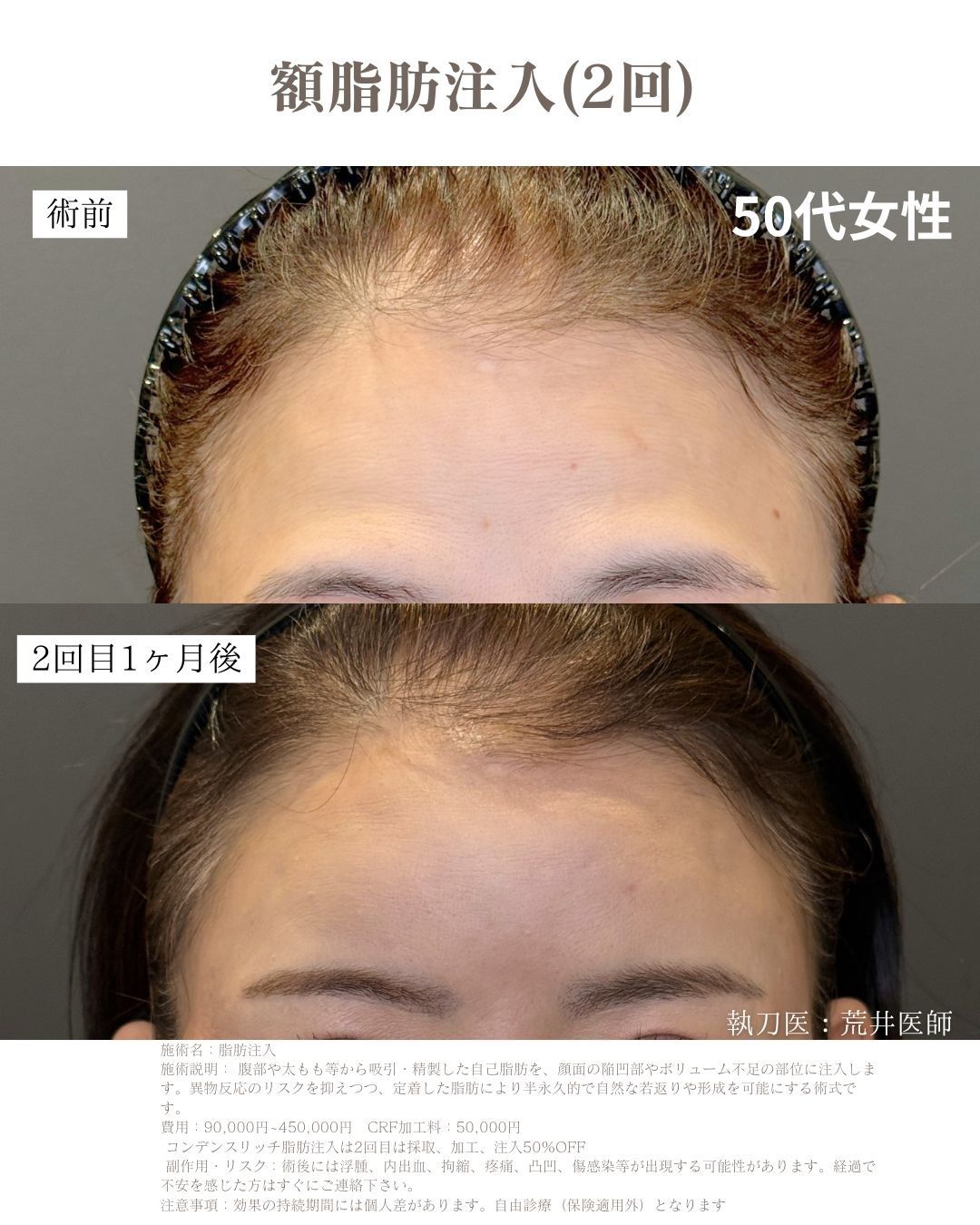 小顔脂肪吸引　脂肪注入