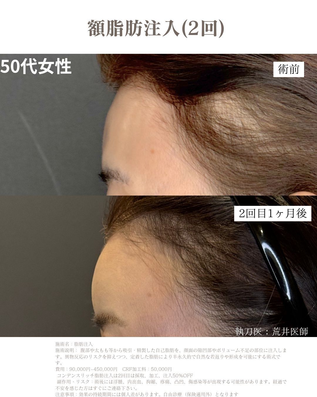 小顔脂肪吸引　脂肪注入