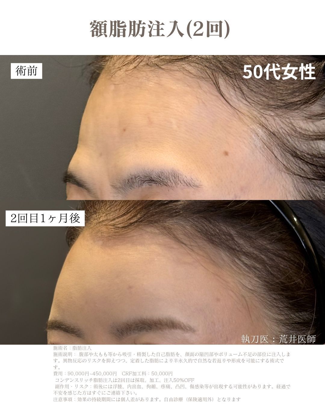 小顔脂肪吸引　脂肪注入