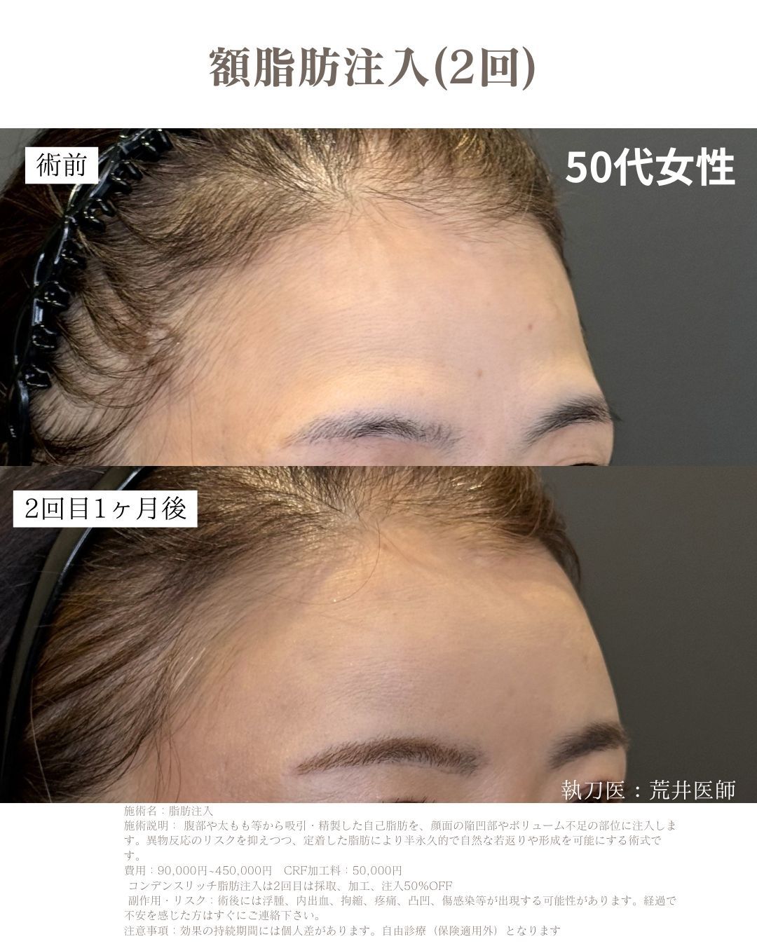 小顔脂肪吸引　脂肪注入