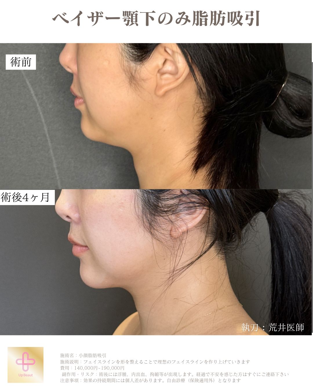 顎下広め脂肪吸引