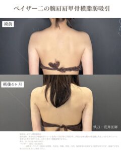 ベイザー二の腕脂肪吸引