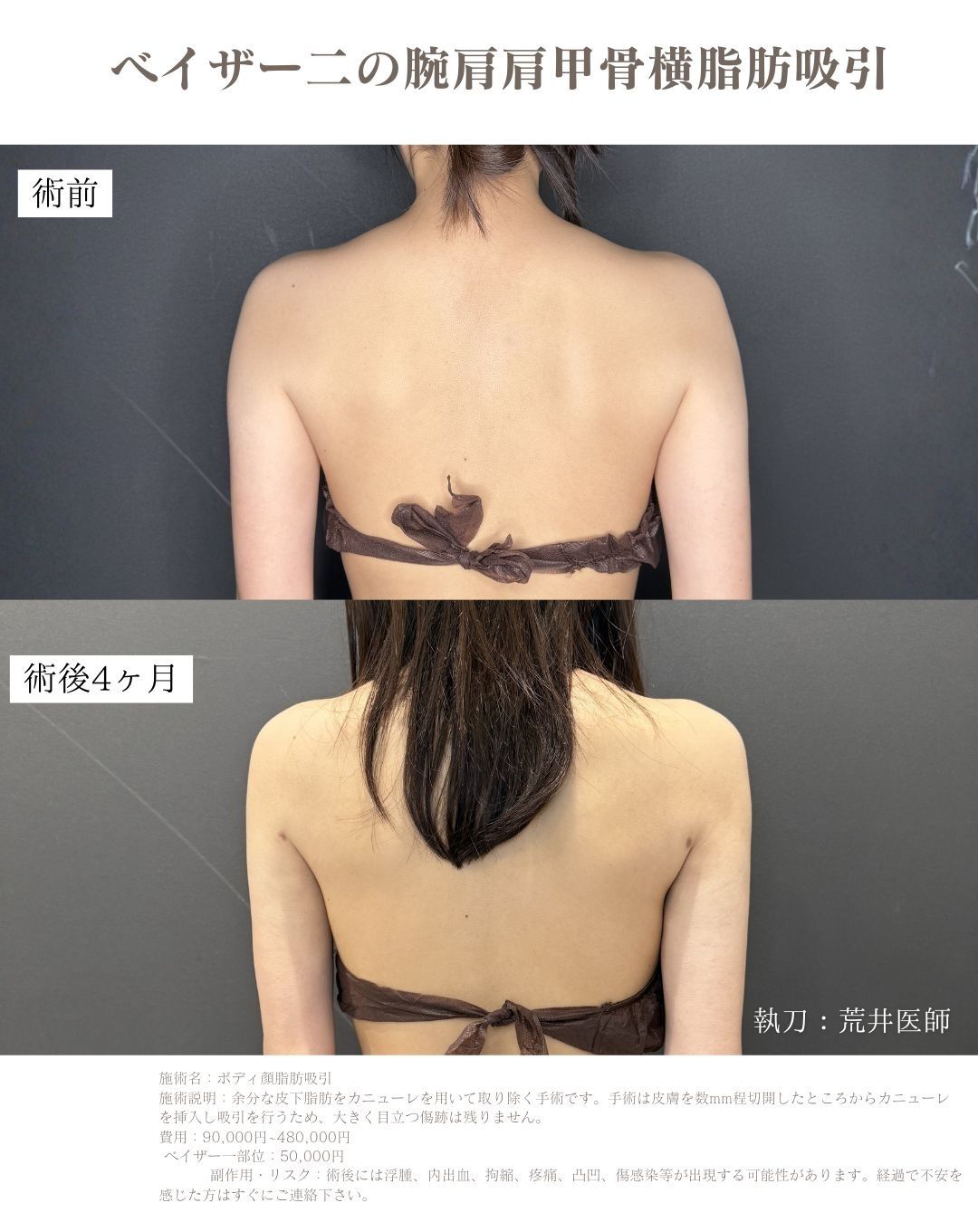 ベイザー二の腕脂肪吸引