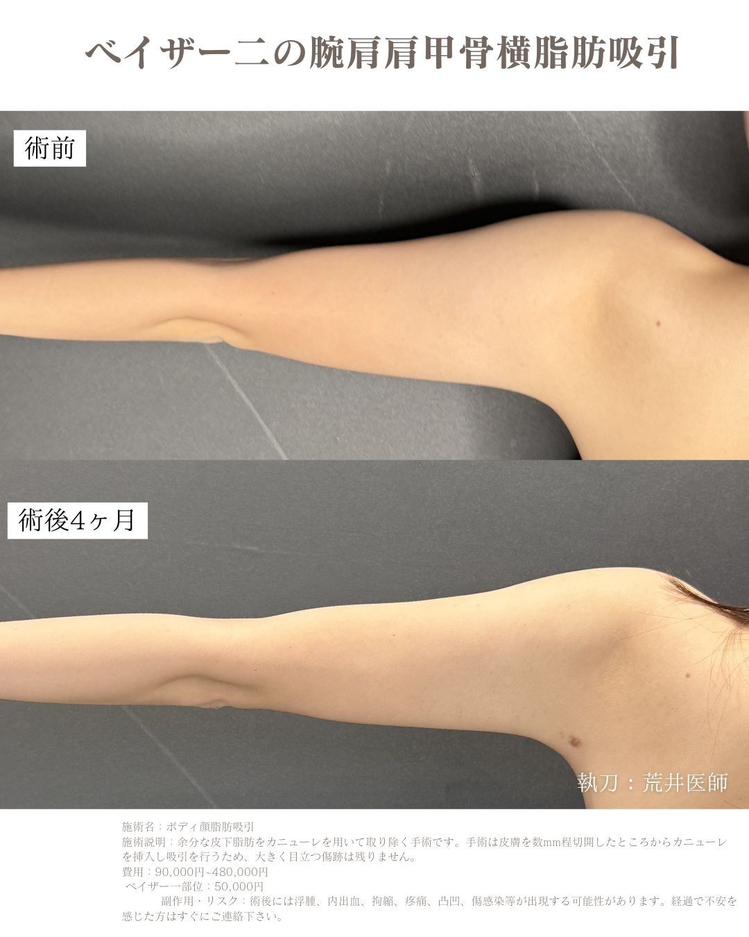 ベイザー二の腕脂肪吸引