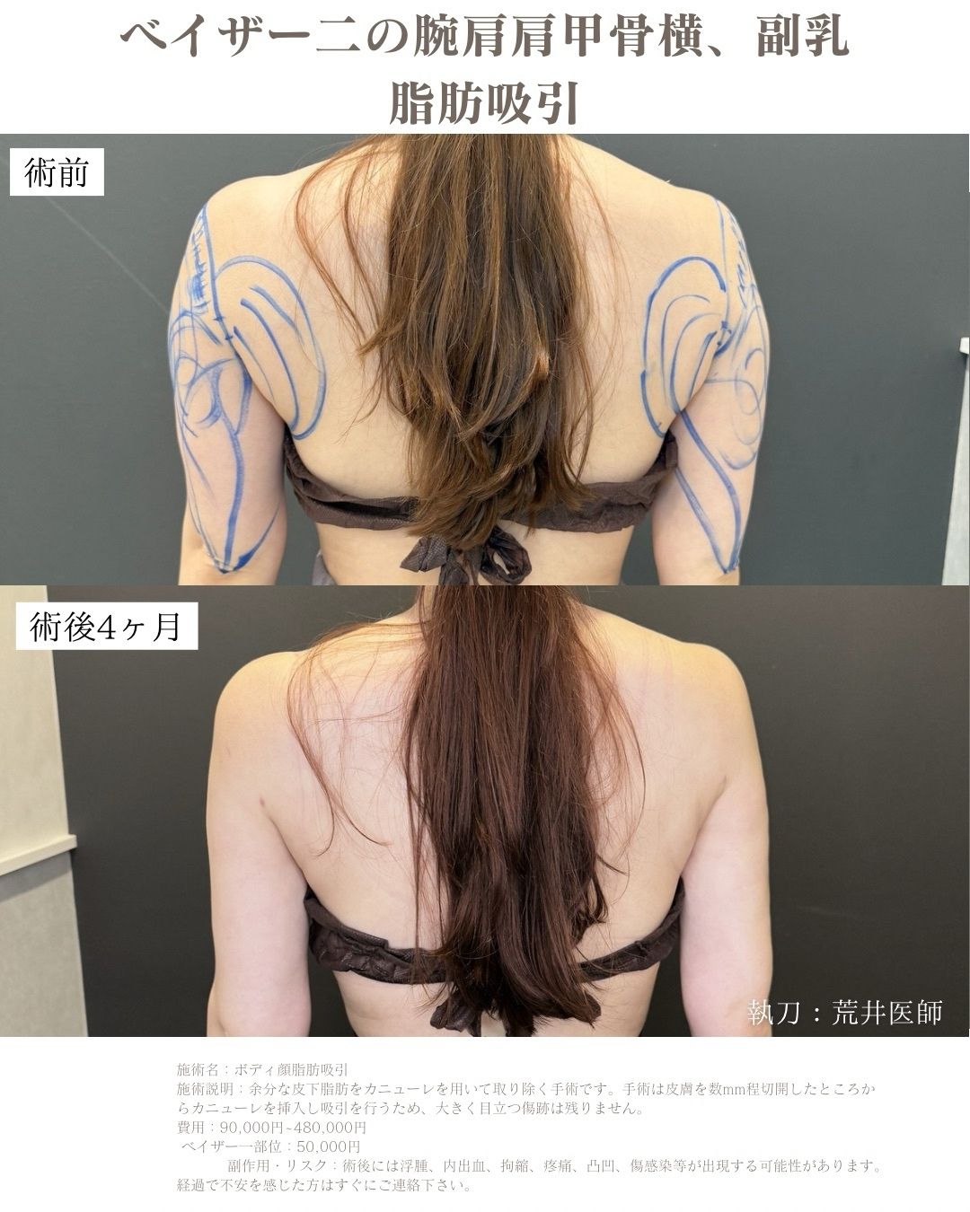 二の腕脂肪吸引
