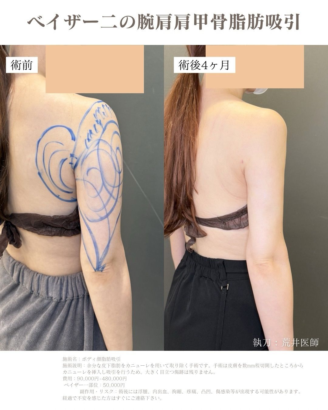 二の腕脂肪吸引