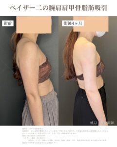二の腕脂肪吸引