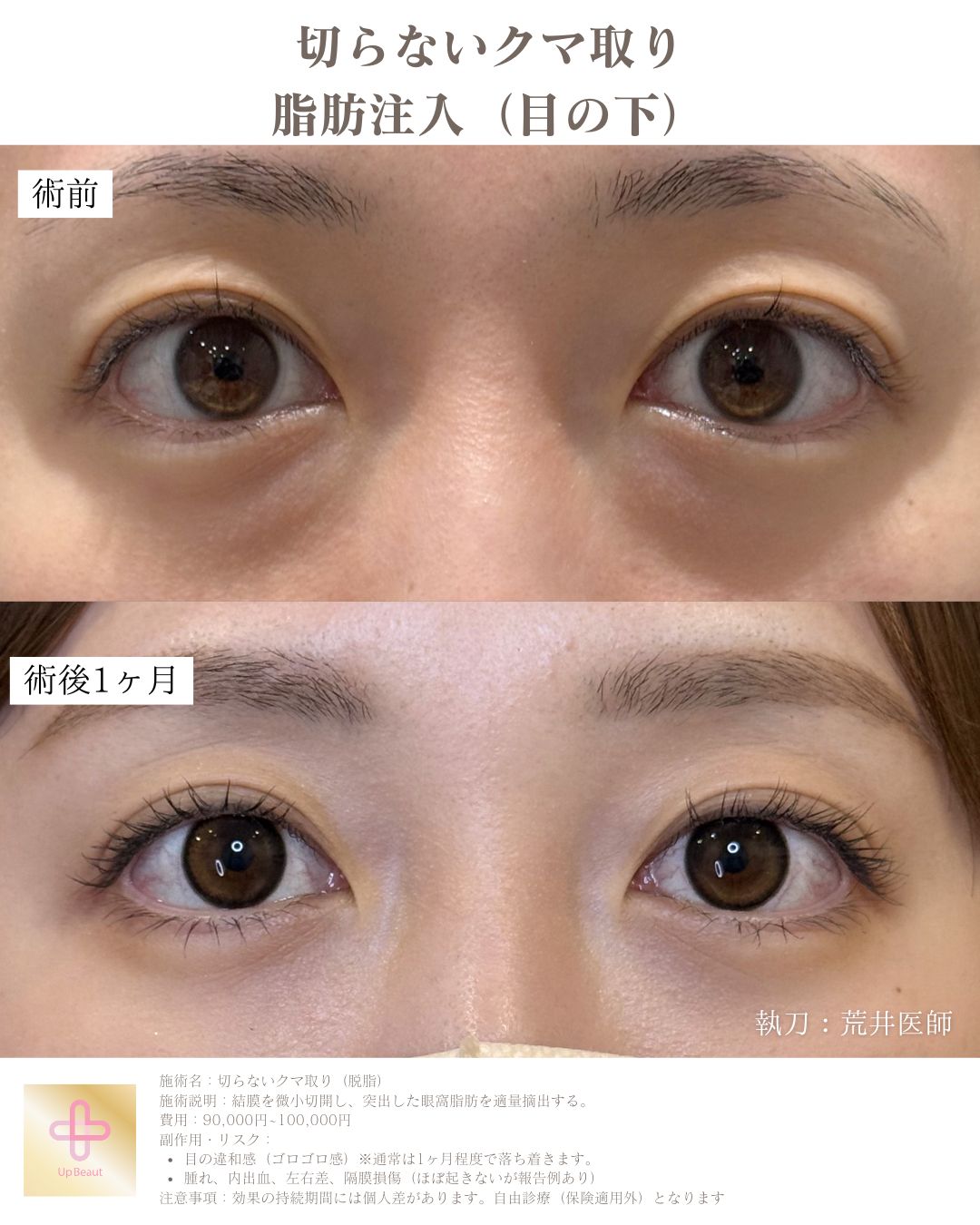 目の下の脱脂、脂肪注入（目の下）