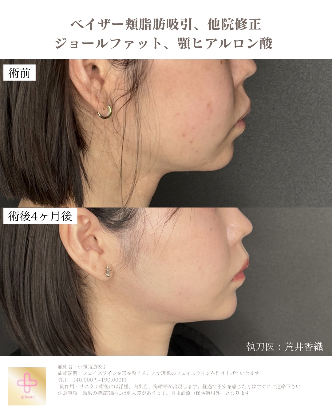 頬脂肪吸引、ジョールファット、顎ヒアルロン酸、他院修正