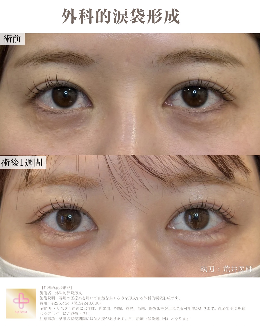 外科的涙袋形成