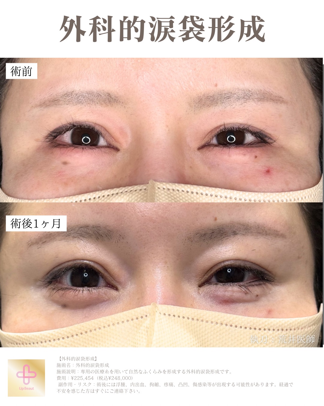 外科的涙袋形成