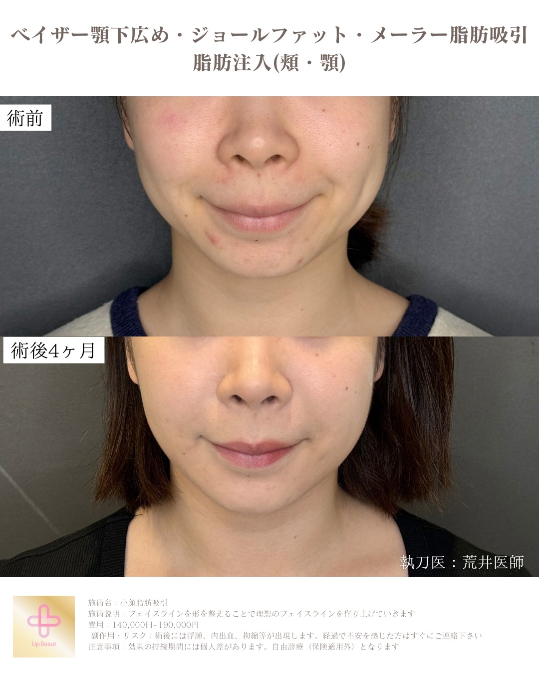 バッカルファット・メーラーファット除去 症例写真