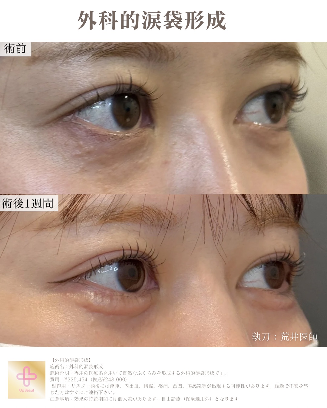 外科的涙袋形成