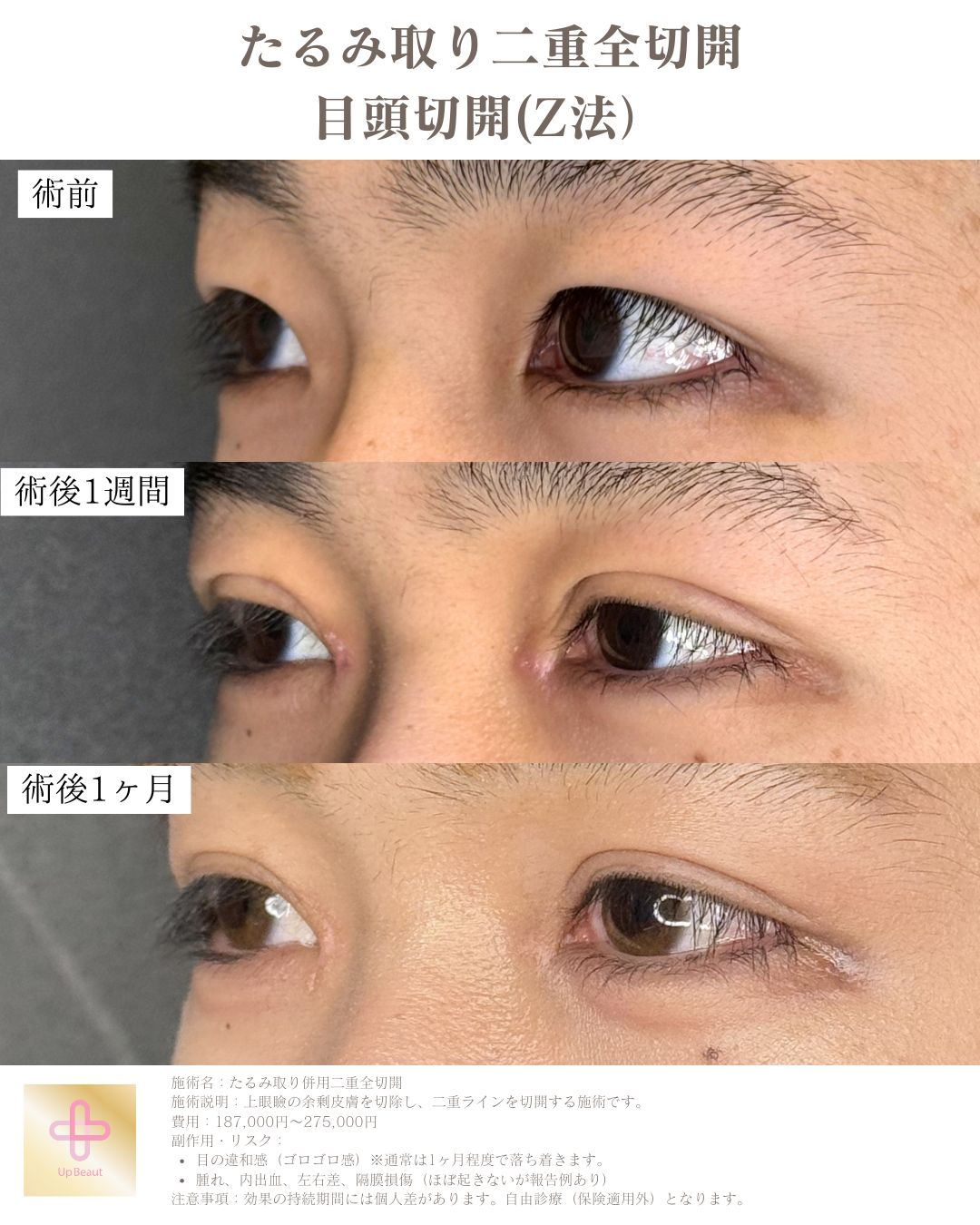 たるみ取り併用全切開二重術、目頭切開(Z法)