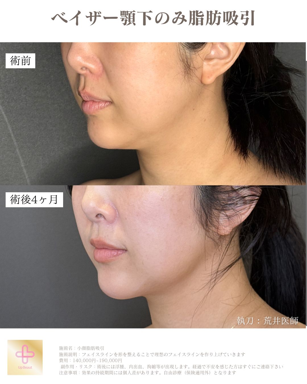 顎下広め脂肪吸引