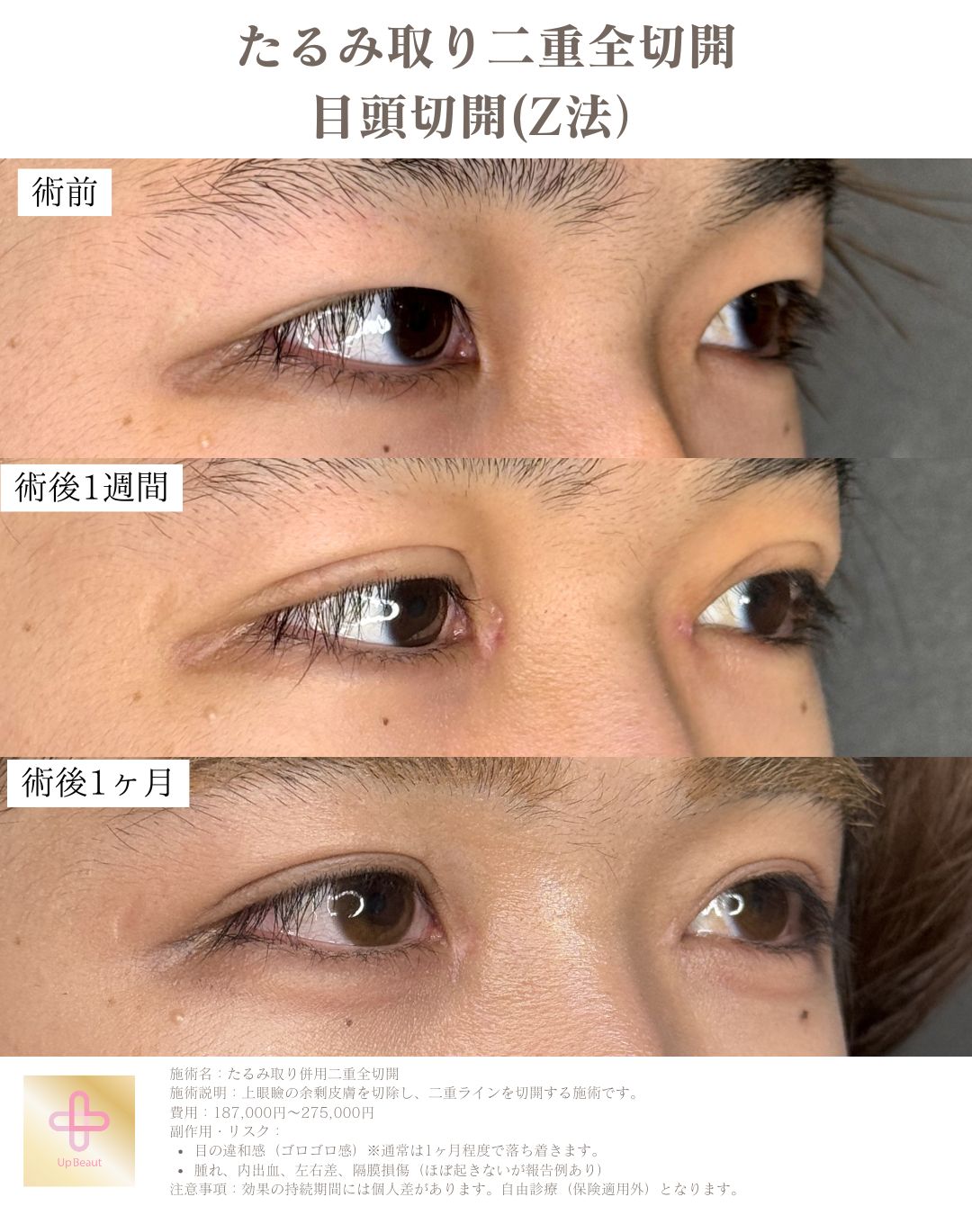 たるみ取り併用全切開二重術、目頭切開(Z法)