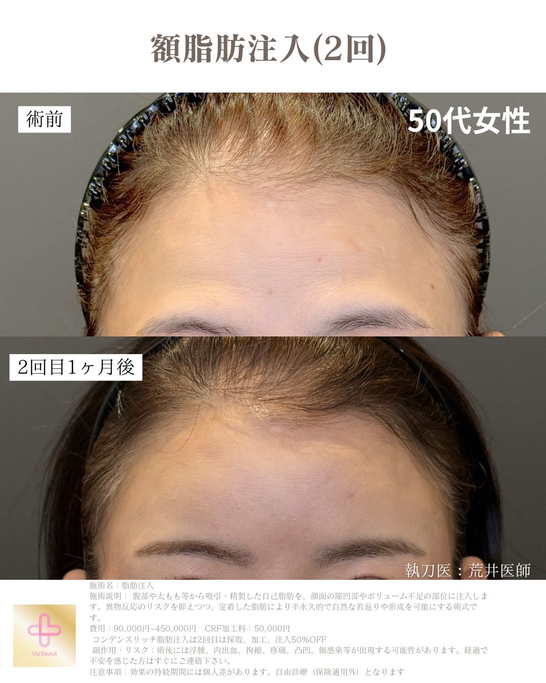 顎下のみ脂肪吸引、ジョールファット、バッカルファット、糸リフト８本、エラボトックス、脂肪注入(ほうれい線１回、額２回)
