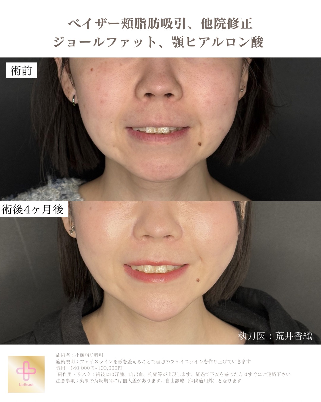 頬脂肪吸引、ジョールファット、顎ヒアルロン酸、他院修正