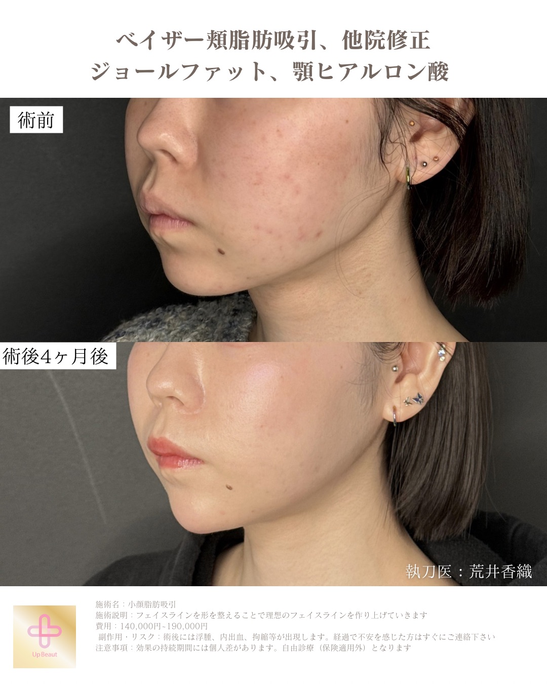 頬脂肪吸引、ジョールファット、顎ヒアルロン酸、他院修正