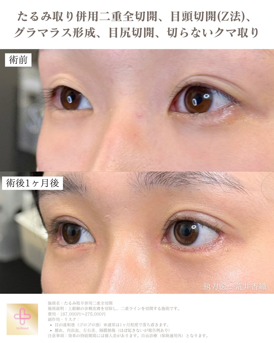 たるみ取り併用二重全切開、目頭切開(Z法) 、グラマラス形成、目尻切開、切らないクマ取り