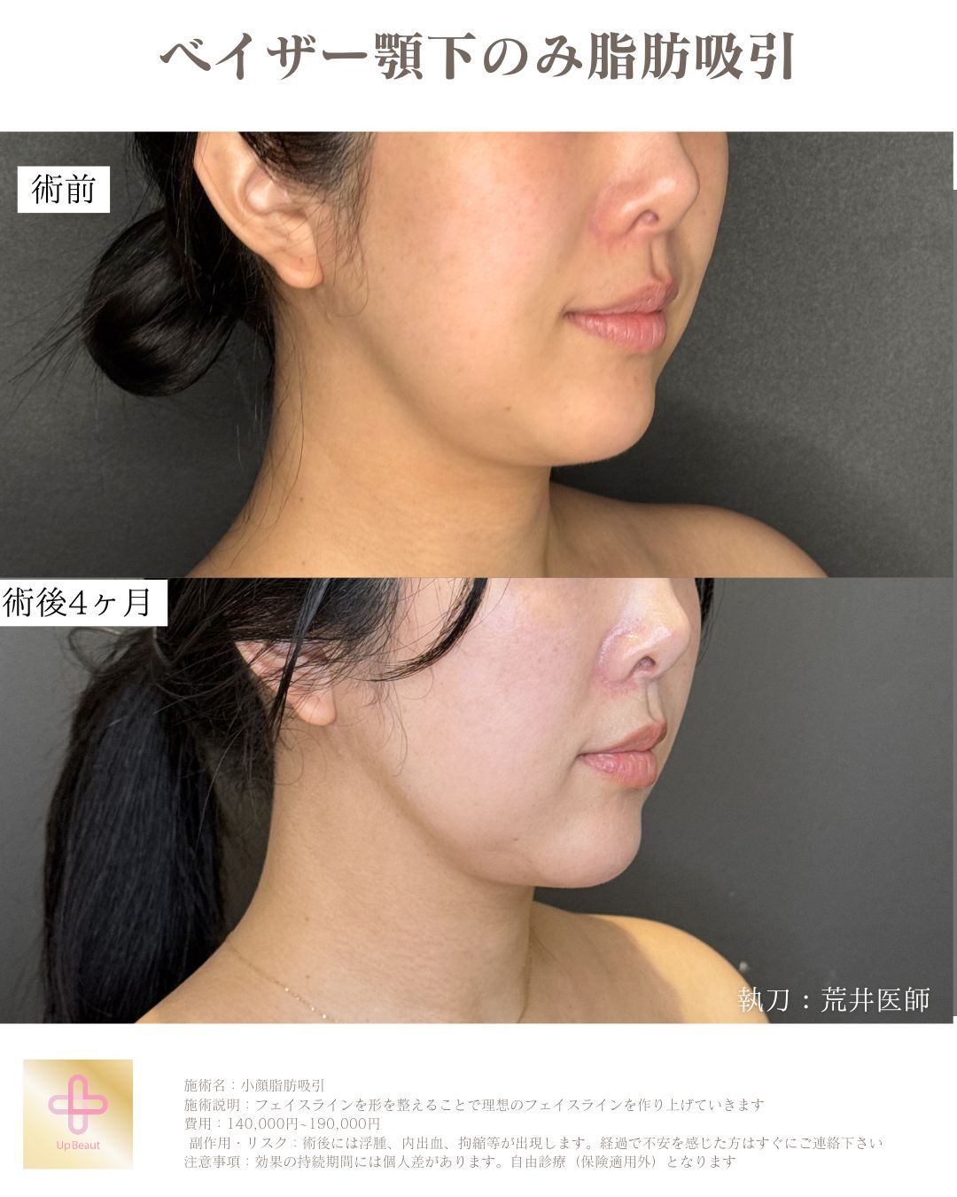 顎下広め脂肪吸引