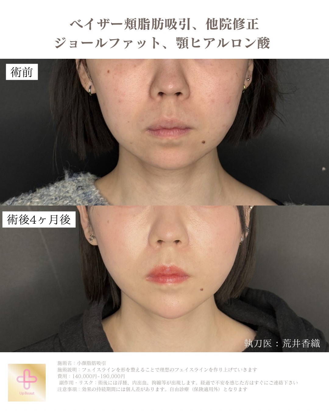 頬脂肪吸引、ジョールファット、顎ヒアルロン酸、他院修正