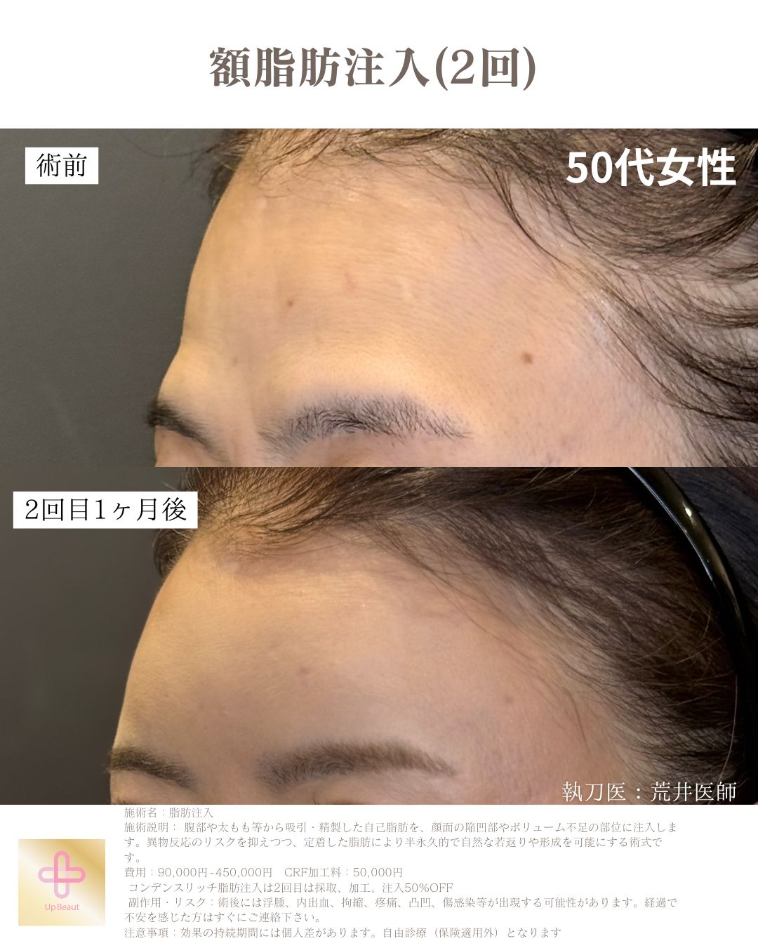 顎下のみ脂肪吸引、ジョールファット、バッカルファット、糸リフト８本、エラボトックス、脂肪注入(ほうれい線１回、額２回)