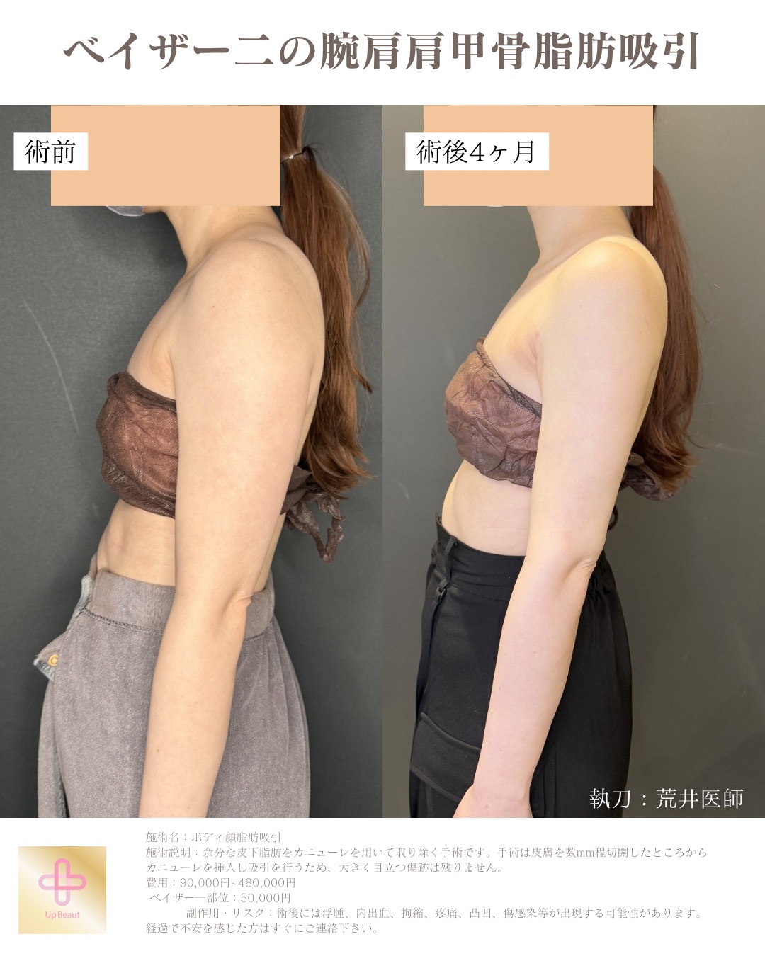 VASER脂肪吸引 症例1