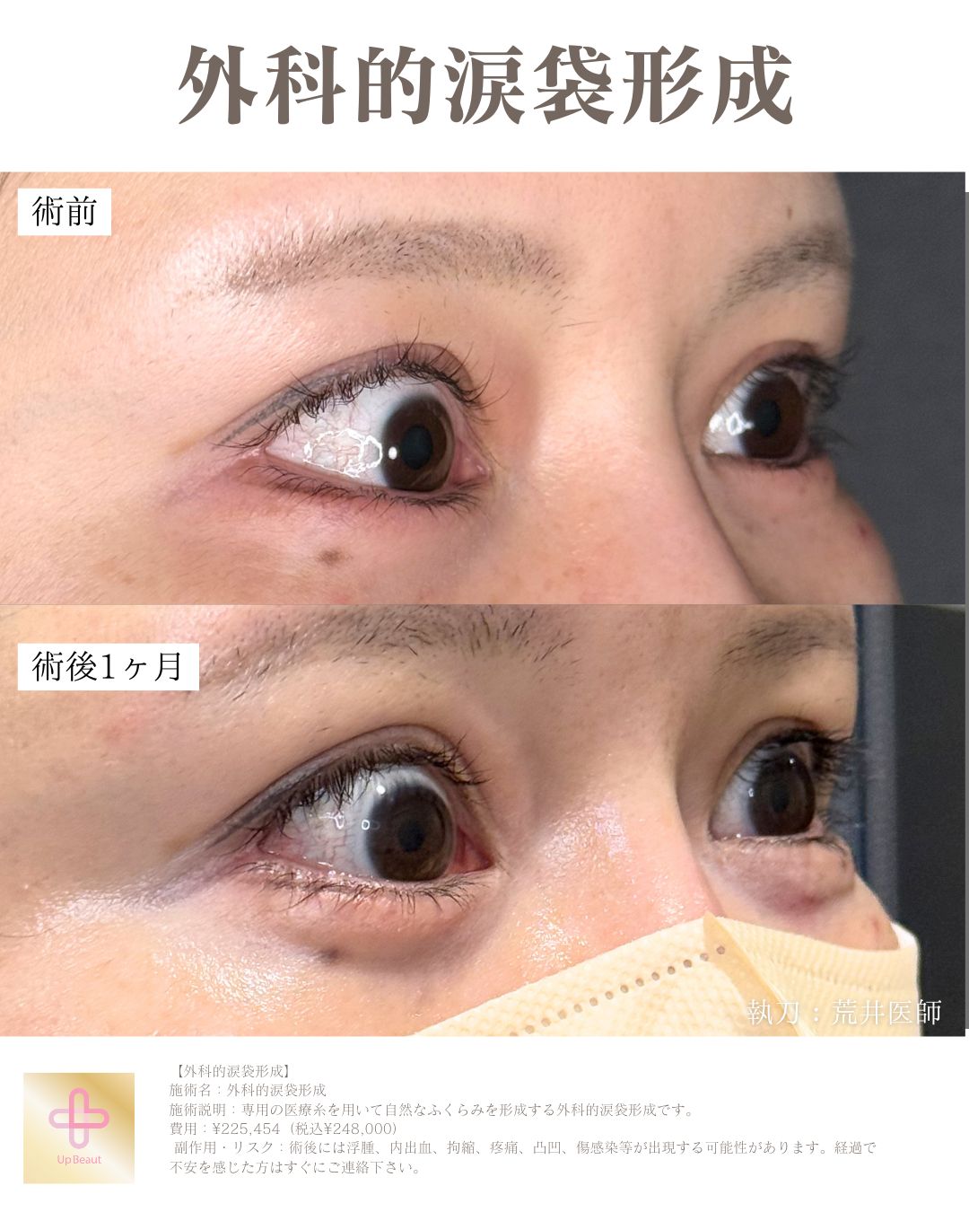 外科的涙袋形成