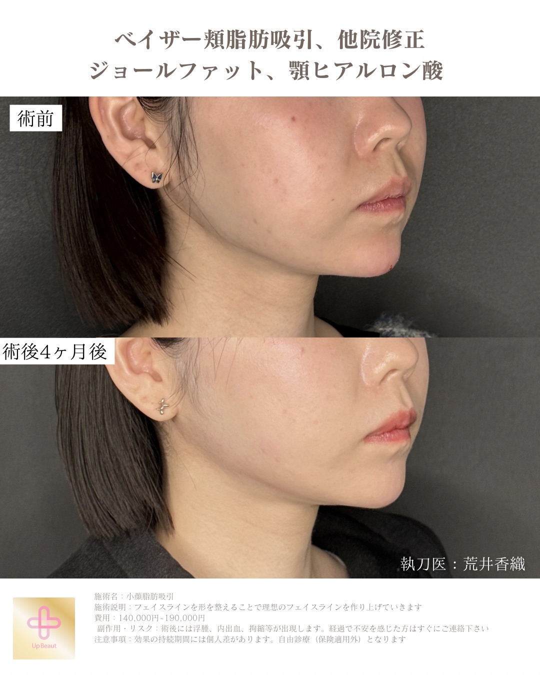 頬脂肪吸引、ジョールファット、顎ヒアルロン酸、他院修正