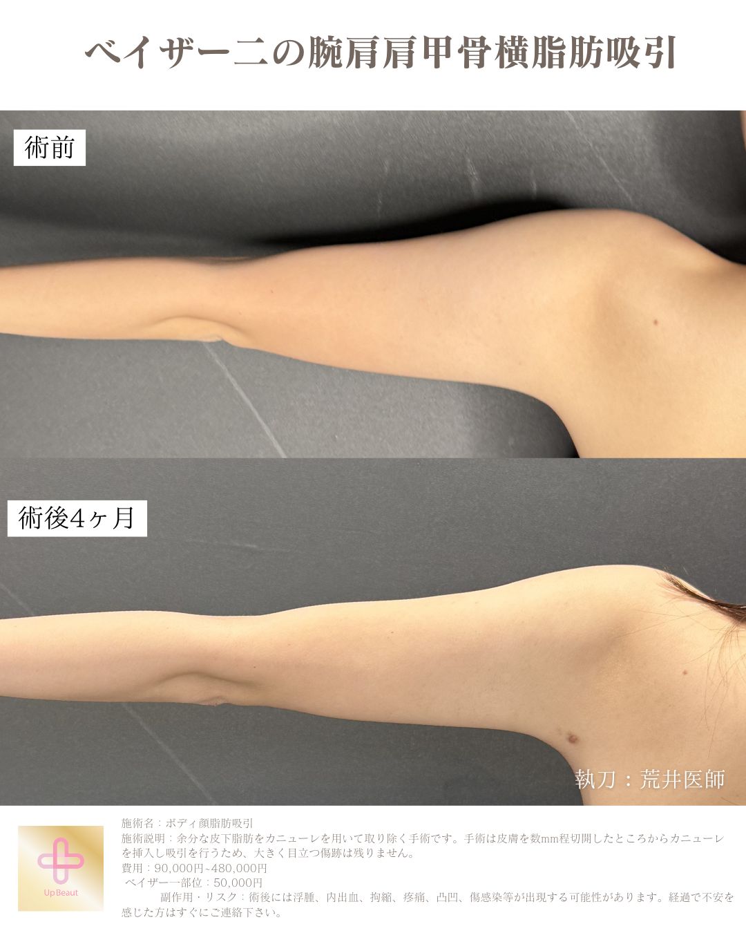 二の腕肩肩甲骨横脂肪吸引