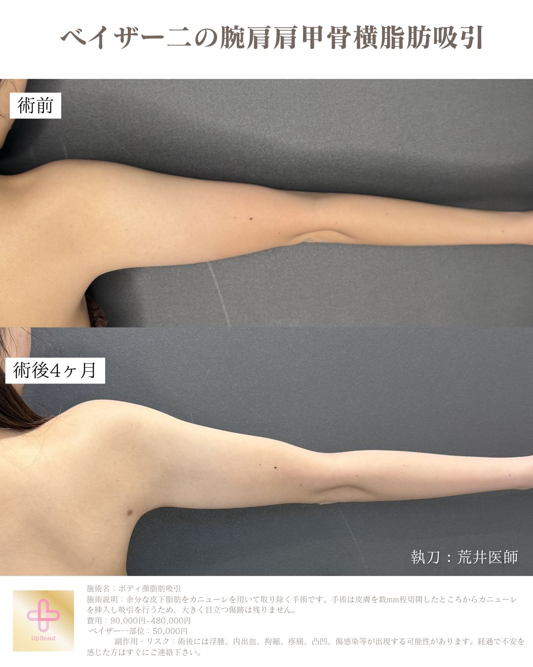 二の腕肩肩甲骨横脂肪吸引